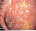 /album/galeria-de-fotos-a-saude-de-seu-intestino1/intestino-super-inflamado-jpg/